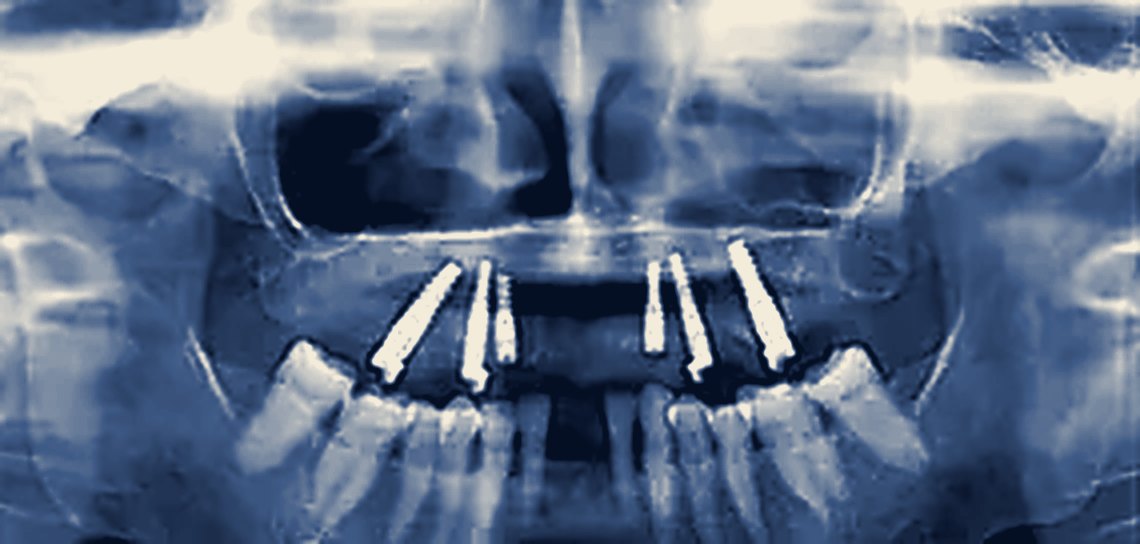 Real patient X-ray: All-on-6 dental implants by Dr Bharat Agravat