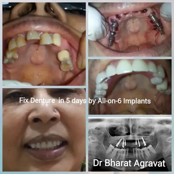 Fixed denture in 5 days with All-on-6 implants by Dr Bharat Agravat