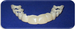 What is One Touch Smile™ Cosmetic veneer india